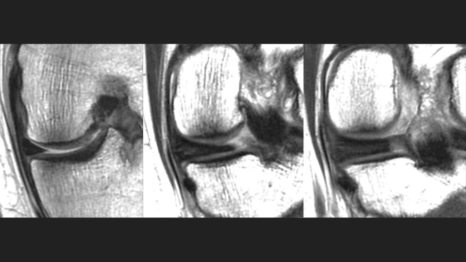 Figure 2 for case posterior horn of medial meniscus ( RID2776 )